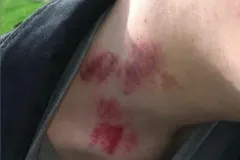 MacKenzie Poltergeist injury