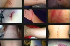 Mackenzie Poltergeist Injuries