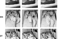 Fatal Familial Insomnia patient