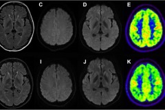 Fatal Familial Insomnia brain